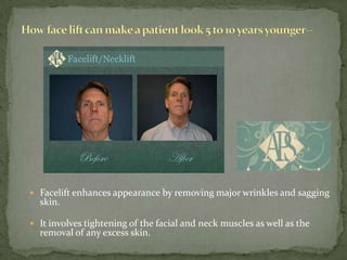 Howface lift can make a patient look 5 to 10 years younger--Facelift enhances appearance by removing major wrinkles and sagging skin.It involves tightening of the facial and neck muscles as well as the removal of any excess skin.