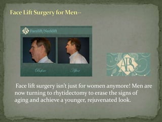     Face lift surgery isn’t just for women anymore! Men are now turning to rhytidectomy to erase the signs of aging and achieve a younger, rejuvenated look. Face Lift Surgery for Men--
