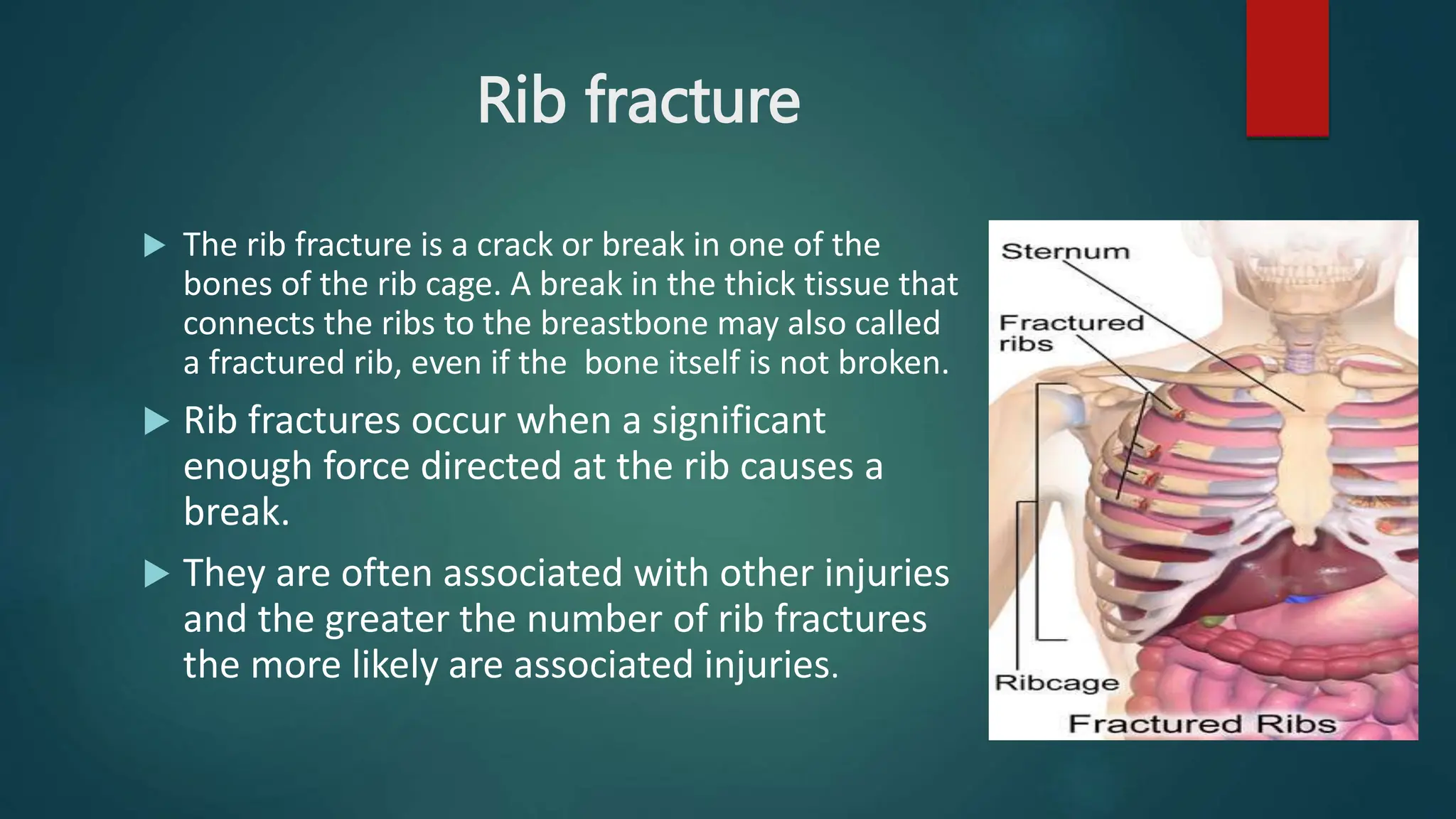 Fraction Ribs Rib Fractures, Flail Chest & Stove In Chest | PPTX