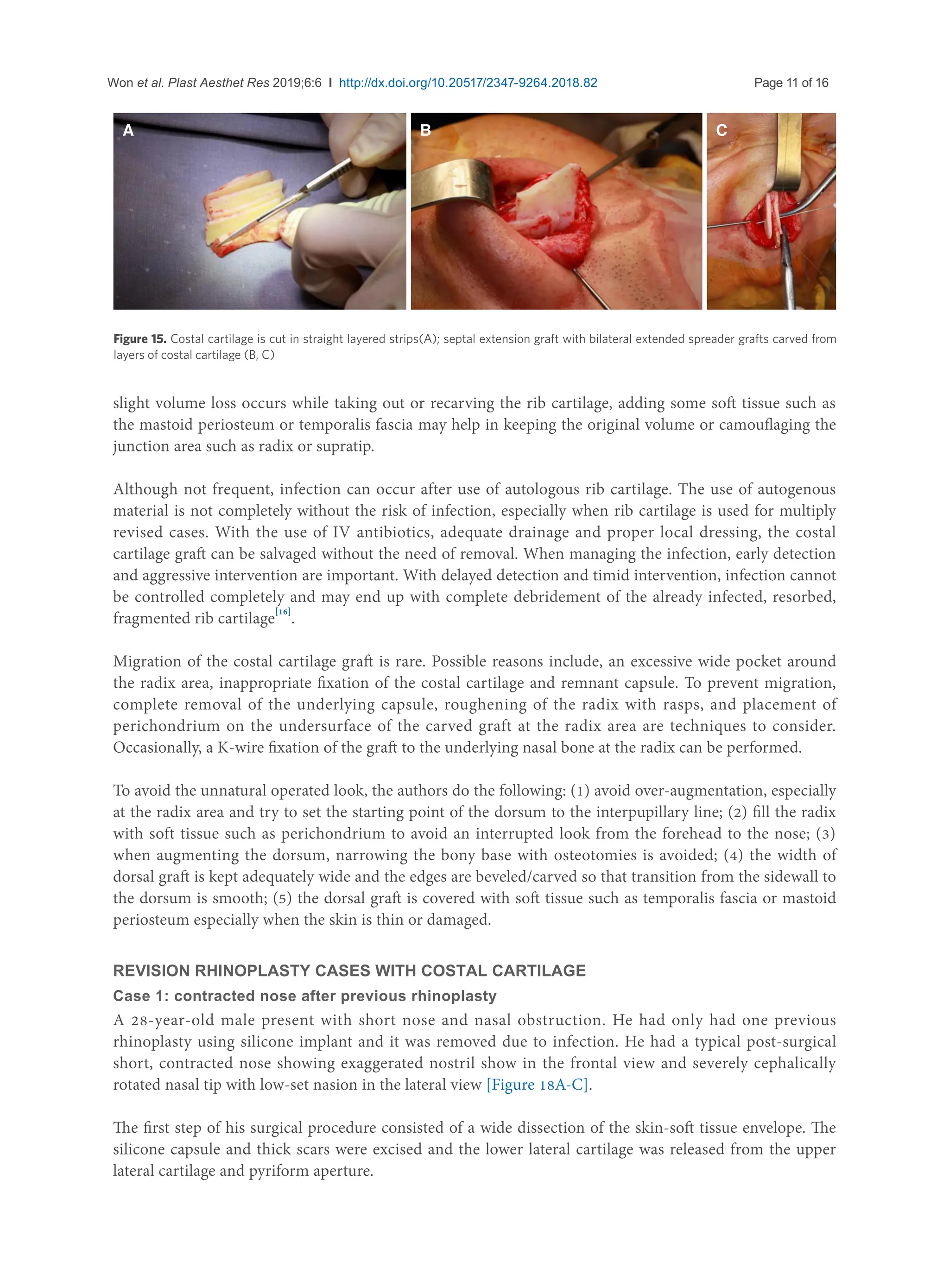 rib graft for rhinoplasty. revision rhino using autologous rib ...