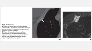 The spectrum of Rib Neoplasms in adults.pptx