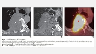 The spectrum of Rib Neoplasms in adults.pptx