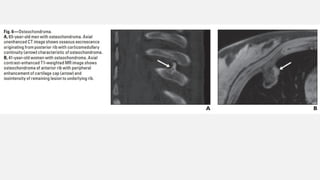 The spectrum of Rib Neoplasms in adults.pptx