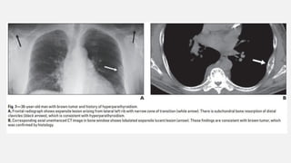 The spectrum of Rib Neoplasms in adults.pptx