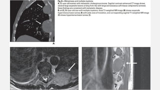 The spectrum of Rib Neoplasms in adults.pptx