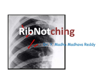 RibNotching
Dr. Y. Madhu Madhava Reddy
 