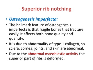 Superior Rib Notching Rib notching | PPTX
