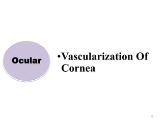 20
Ocular •Vascularization Of
Cornea
 