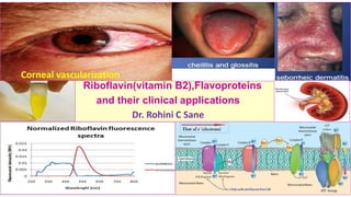 Riboflavin(vitamin B2),Flavoproteins
and their clinical applications
Dr. Rohini C Sane
Corneal vascularization
 