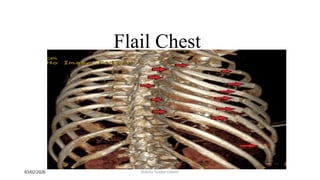 Flailing Ribs ribs fracture, flail chest , pulmonary contusion .pptx