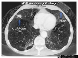 NEJM Weekly Image Challenge
January 19, 2006

A CAUSA
O CÂNCER

 