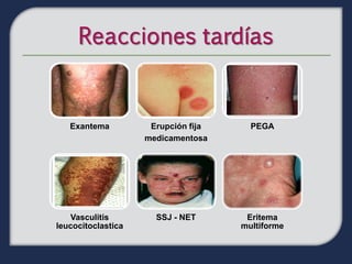 Exantema          Erupción fija     PEGA
                    medicamentosa




   Vasculitis         SSJ - NET       Eritema
leucocitoclastica                    multiforme
 