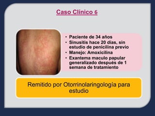 Caso Clínico 6



             • Paciente de 34 años
             • Sinusitis hace 20 días, sin
               estudio de penicilina previo
             • Manejo: Amoxicilina
             • Exantema maculo papular
               generalizado después de 1
               semana de tratamiento


Remitido por Otorrinolaringología para
               estudio
 