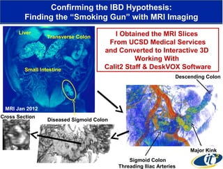 Confirming the IBD Hypothesis:
Finding the “Smoking Gun” with MRI Imaging
Liver

Transverse Colon

Small Intestine

I Obtained the MRI Slices
From UCSD Medical Services
and Converted to Interactive 3D
Working With
Calit2 Staff & DeskVOX Software
Descending Colon

MRI Jan 2012
Cross Section

Diseased Sigmoid Colon

Major Kink
Sigmoid Colon
Threading Iliac Arteries

 