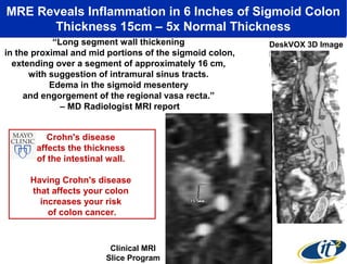 MRE Reveals Inflammation in 6 Inches of Sigmoid Colon
Thickness 15cm – 5x Normal Thickness
“Long segment wall thickening
in the proximal and mid portions of the sigmoid colon,
extending over a segment of approximately 16 cm,
with suggestion of intramural sinus tracts.
Edema in the sigmoid mesentery
and engorgement of the regional vasa recta.”
– MD Radiologist MRI report
Crohn's disease
affects the thickness
of the intestinal wall.
Having Crohn's disease
that affects your colon
increases your risk
of colon cancer.

Clinical MRI
Slice Program

DeskVOX 3D Image

 