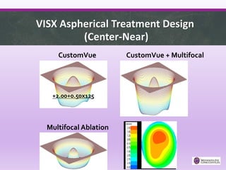 VISX Aspherical Treatment Design
(Center-Near)
CustomVue
Multifocal Ablation
CustomVue + Multifocal
+2.00+0.50x125
 
