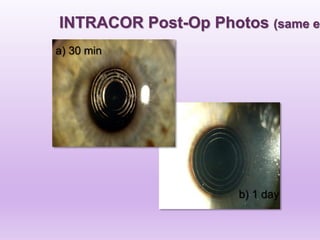 INTRACOR Post-Op Photos (same ey
a) 30 min
b) 1 day
 