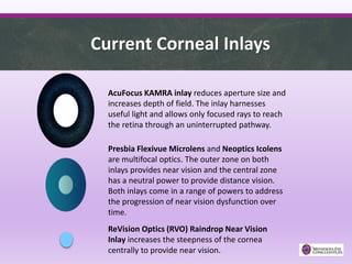 AcuFocus KAMRA inlay reduces aperture size and
increases depth of field. The inlay harnesses
useful light and allows only focused rays to reach
the retina through an uninterrupted pathway.
Presbia Flexivue Microlens and Neoptics Icolens
are multifocal optics. The outer zone on both
inlays provides near vision and the central zone
has a neutral power to provide distance vision.
Both inlays come in a range of powers to address
the progression of near vision dysfunction over
time.
ReVision Optics (RVO) Raindrop Near Vision
Inlay increases the steepness of the cornea
centrally to provide near vision.
Current Corneal Inlays
 