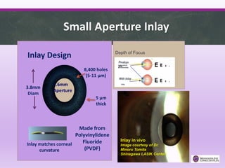 Small Aperture Inlay
1.6mm
Aperture
5 μm
thick
Made from
Polyvinylidene
Fluoride
(PVDF)
8,400 holes
(5-11 μm)
Inlay matches corneal
curvature
3.8mm
Diam
Inlay Design
Presbyo
pia
With Inlay
Inlay
Lens cannot
accommodate
Depth of Focus
Inlay in vivo
Image courtesy of Dr.
Minoru Tomita
Shinagawa LASIK Center
 