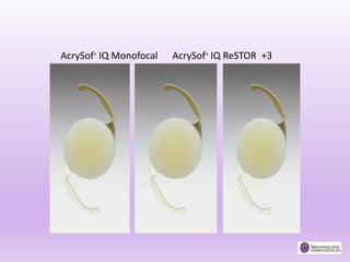 AcrySof® IQ Monofocal AcrySof® IQ ReSTOR +3
AcrySof® IQ Toric
 