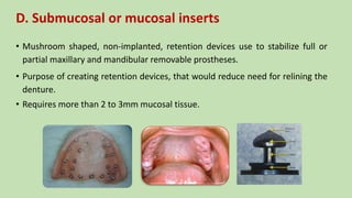D. Submucosal or mucosal inserts
• Mushroom shaped, non-implanted, retention devices use to stabilize full or
partial maxillary and mandibular removable prostheses.
• Purpose of creating retention devices, that would reduce need for relining the
denture.
• Requires more than 2 to 3mm mucosal tissue.
 