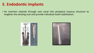 E. Endodontic implants
• An insertion extends through root canal into periapical osseous structure to
lengthen the existing root and provide individual tooth stabilization.
 