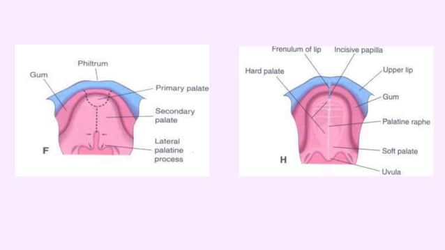 CLEFT LIP AND PALATE | PPTX