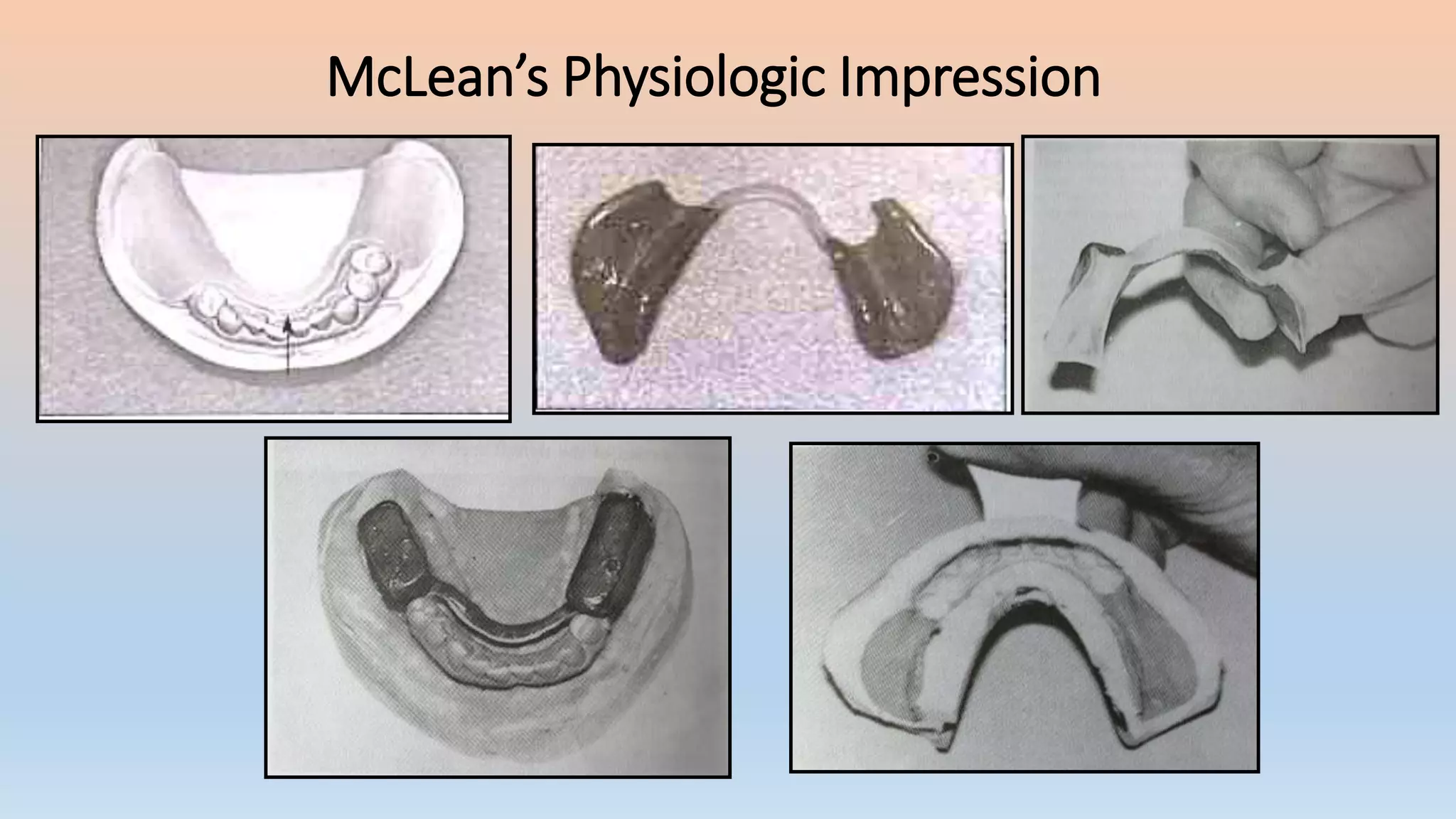 McLean’s Physiologic Impression
 