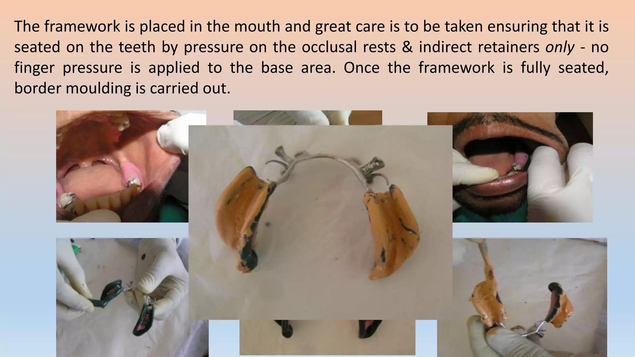The framework is placed in the mouth and great care is to be taken ensuring that it is
seated on the teeth by pressure on the occlusal rests & indirect retainers only - no
finger pressure is applied to the base area. Once the framework is fully seated,
border moulding is carried out.
 