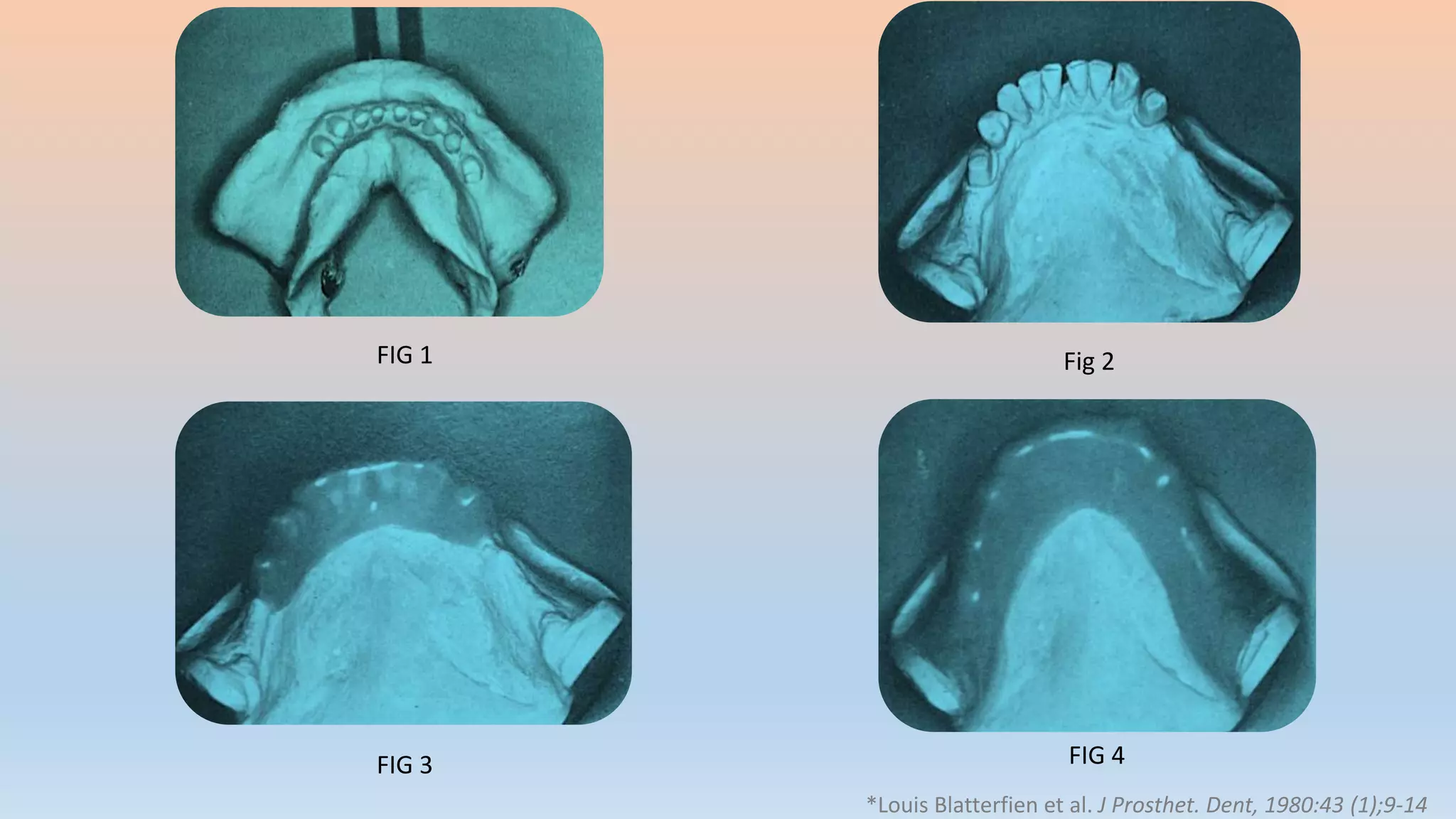*Louis Blatterfien et al. J Prosthet. Dent, 1980:43 (1);9-14
FIG 1 Fig 2
FIG 3 FIG 4
 