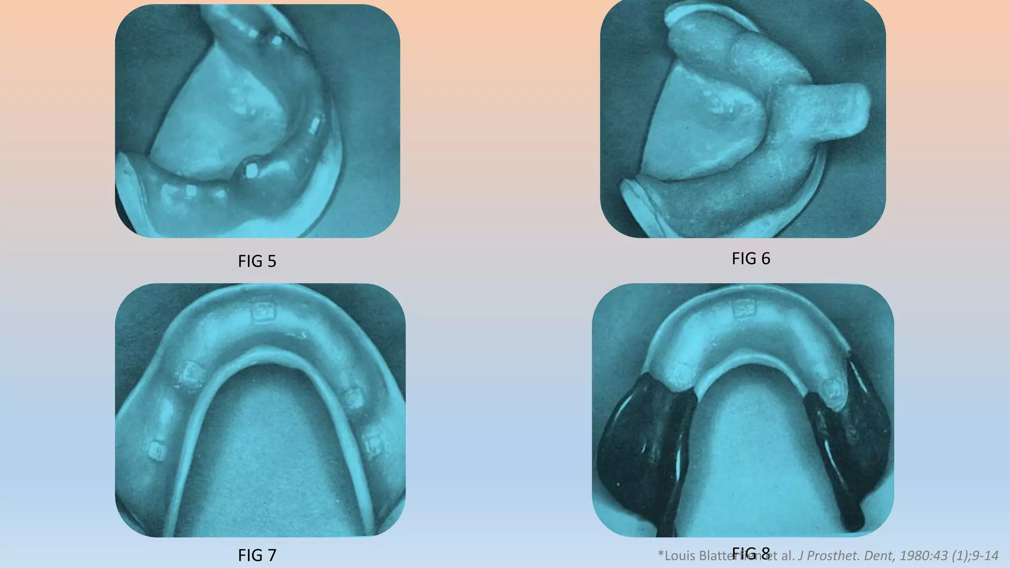 FIG 5 FIG 6
FIG 7 FIG 8*Louis Blatterfien et al. J Prosthet. Dent, 1980:43 (1);9-14
 