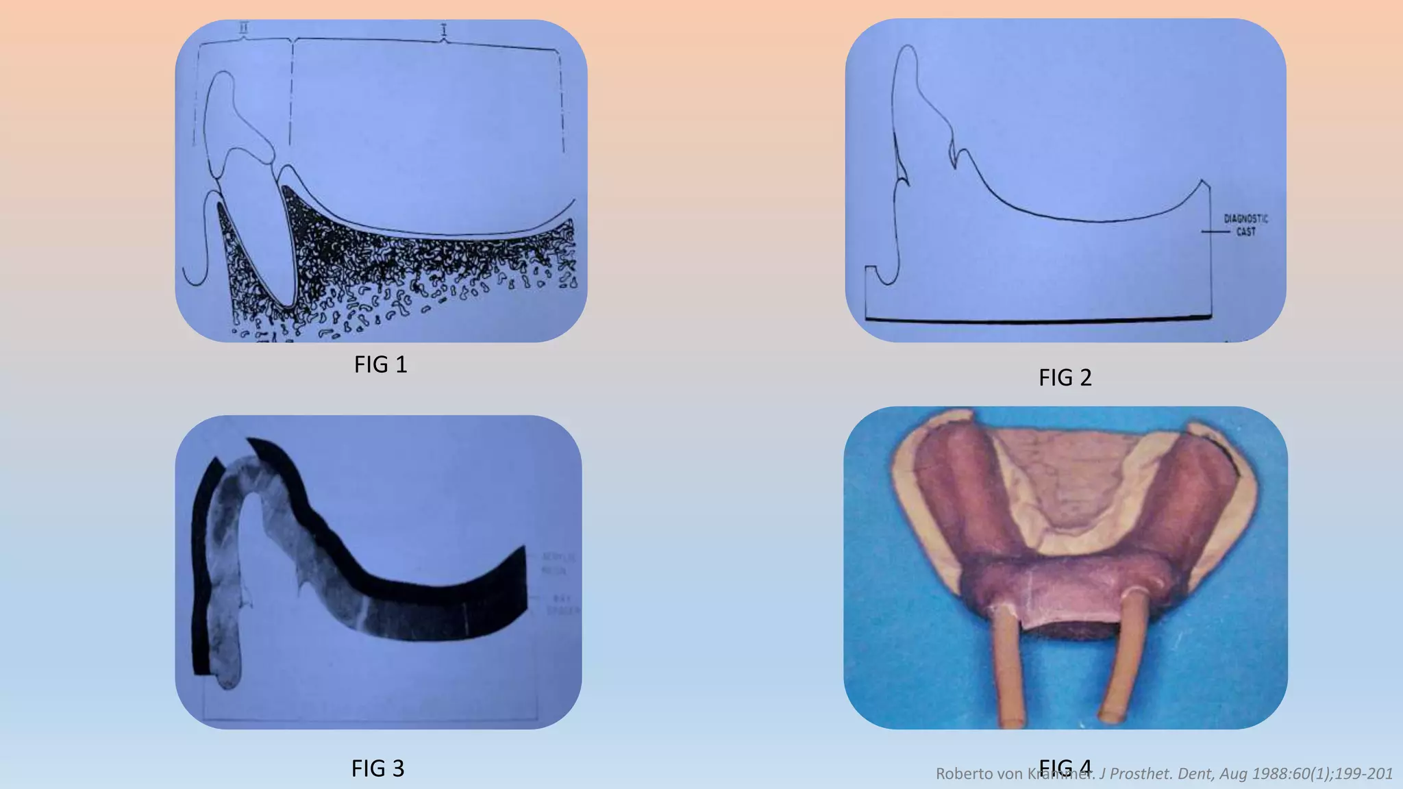 FIG 1 FIG 2
FIG 3 FIG 4Roberto von Krammer. J Prosthet. Dent, Aug 1988:60(1);199-201
 