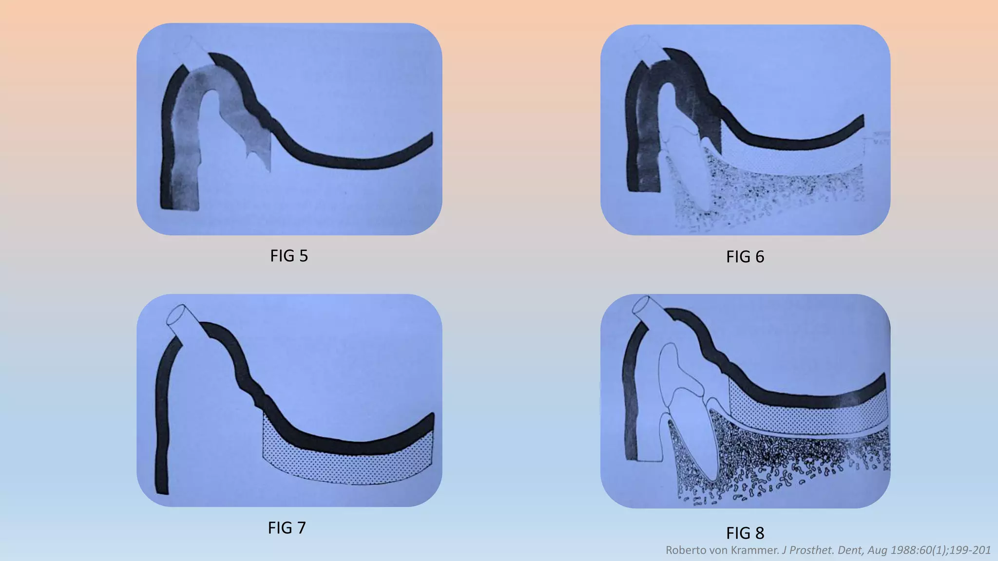 FIG 5 FIG 6
FIG 7 FIG 8
Roberto von Krammer. J Prosthet. Dent, Aug 1988:60(1);199-201
 