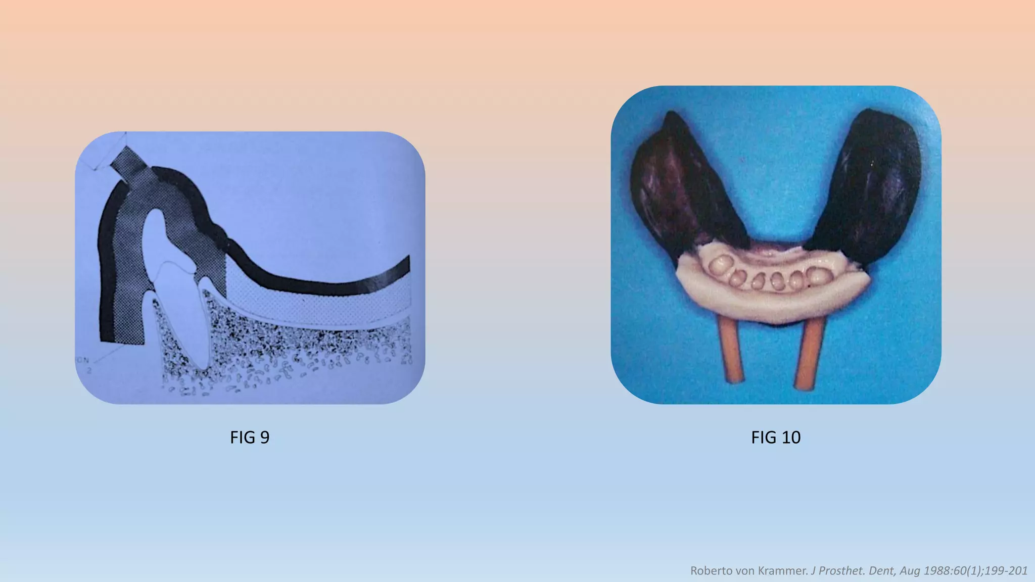 FIG 9 FIG 10
Roberto von Krammer. J Prosthet. Dent, Aug 1988:60(1);199-201
 