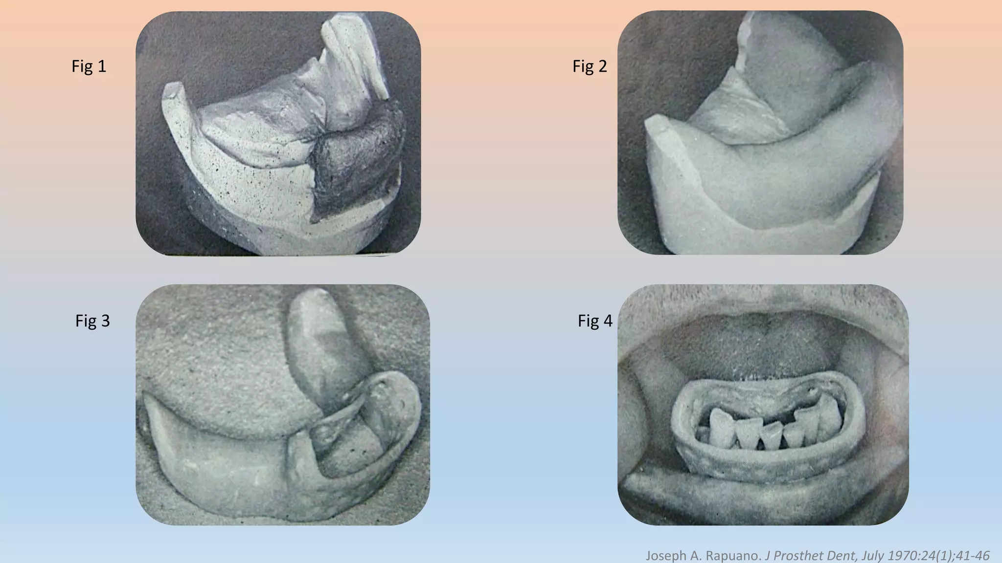 Joseph A. Rapuano. J Prosthet Dent, July 1970:24(1);41-46
Fig 1 Fig 2
Fig 3 Fig 4
 