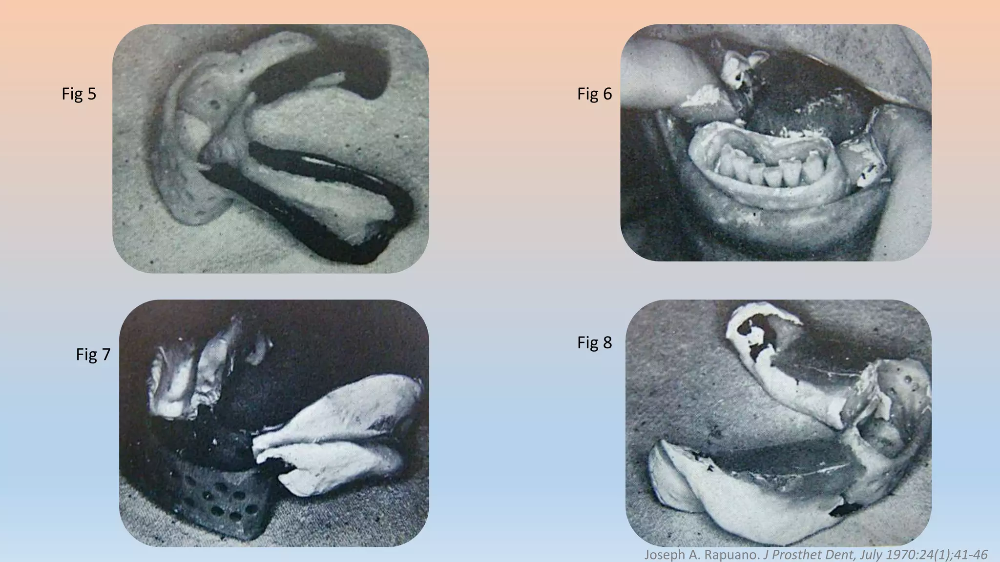 Fig 5 Fig 6
Fig 7
Fig 8
Joseph A. Rapuano. J Prosthet Dent, July 1970:24(1);41-46
 