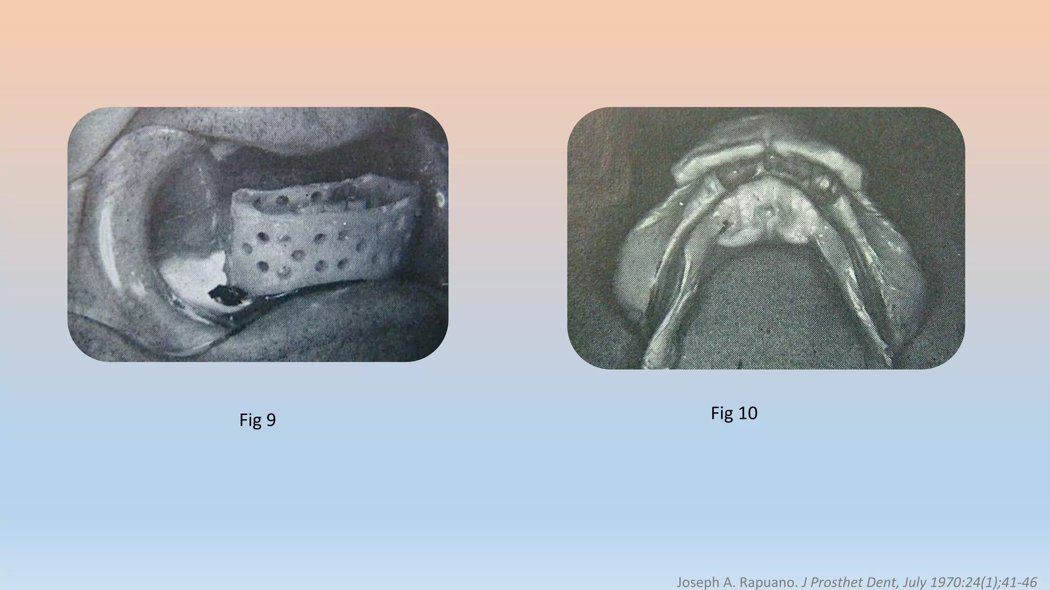 Fig 9 Fig 10
Joseph A. Rapuano. J Prosthet Dent, July 1970:24(1);41-46
 