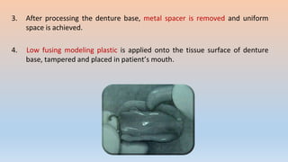 3. After processing the denture base, metal spacer is removed and uniform
space is achieved.
4. Low fusing modeling plastic is applied onto the tissue surface of denture
base, tampered and placed in patient’s mouth.
 