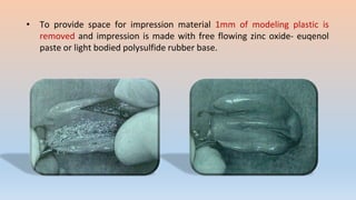 • To provide space for impression material 1mm of modeling plastic is
removed and impression is made with free flowing zinc oxide- euqenol
paste or light bodied polysulfide rubber base.
 