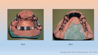 FIG 3 FIG 4
Contemp Clin Dent. 2010 Apr-Jun; 1(2): 103–1
 