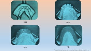 *Louis Blatterfien et al. J Prosthet. Dent, 1980:43 (1);9-14
FIG 1 Fig 2
FIG 3 FIG 4
 