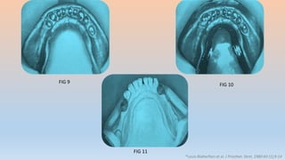 FIG 9
FIG 10
FIG 11
*Louis Blatterfien et al. J Prosthet. Dent, 1980:43 (1);9-14
 