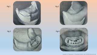 Joseph A. Rapuano. J Prosthet Dent, July 1970:24(1);41-46
Fig 1 Fig 2
Fig 3 Fig 4
 