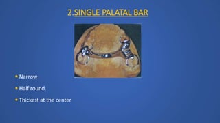 2.SINGLE PALATAL BAR
 Narrow
 Half round.
 Thickest at the center
 
