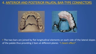 4. ANTERIOR AND POSTERIOR PALATAL BAR-TYPE CONNECTORS
 The two bars are joined by flat longitudinal elements on each side of the lateral slopes
of the palate thus providing 2 bars at different planes “L beam effect”.
 