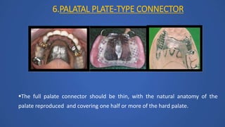 6.PALATAL PLATE-TYPE CONNECTOR
The full palate connector should be thin, with the natural anatomy of the
palate reproduced and covering one half or more of the hard palate.
 