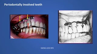 Periodontally involved teeth
SWING LOCK RPD
 