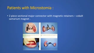 Patients with Microstomia :
• 2 piece sectional major connector with magnetic retainers – cobalt
samarium magnet .
 