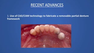 RECENT ADVANCES
1. Use of CAD/CAM technology to fabricate a removable partial denture
framework
 