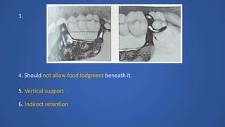 3.
4. Should not allow food lodgment beneath it.
5. Vertical support
6. Indirect retention
 